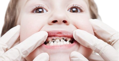 серебрение зуба