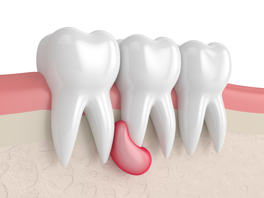 Эффект от удаления кисты зуба