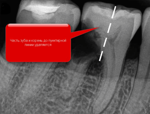 гемисекция корня зуба