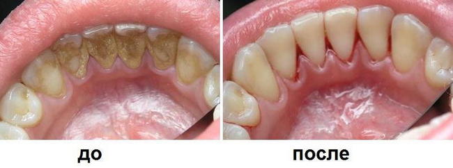 zubnoj-nalet2.jpg