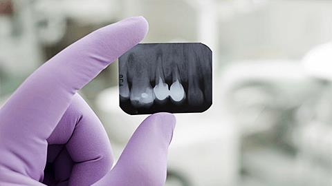 Ренгеновский снимок зуба