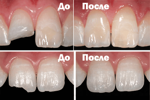 Реставрация зубов: до и после