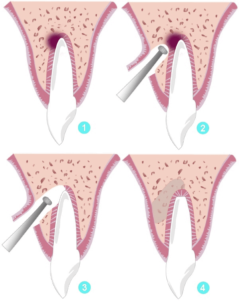 Этапы резекции корня зуба