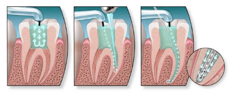 депофорез в стоматологии