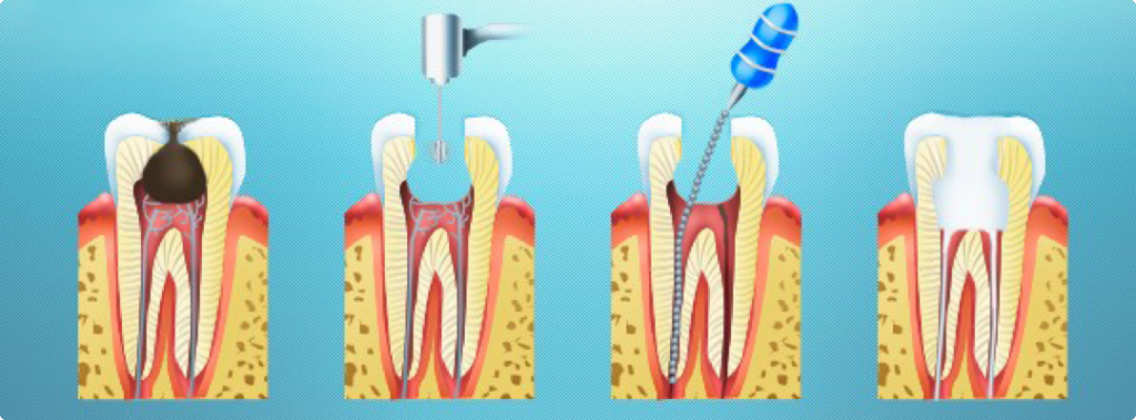 udalenie-nerva-zuba2