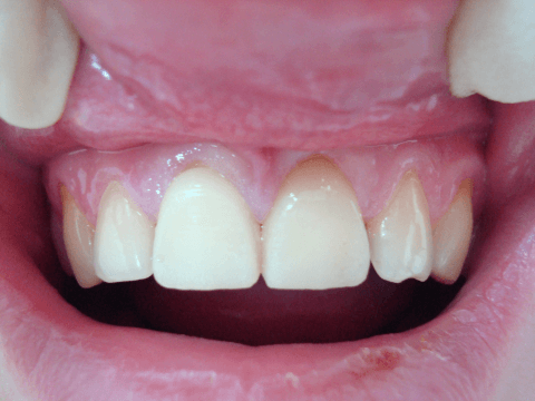 временные коронки на импланты зубов
