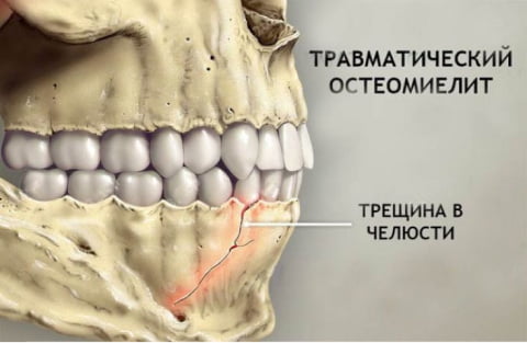 остеомиелит челюсти