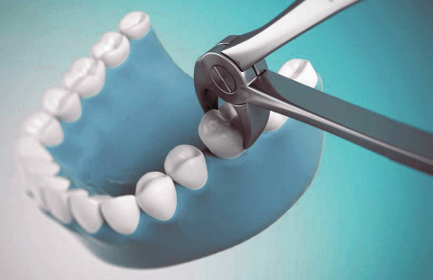 Щипцы для удаления зуба
