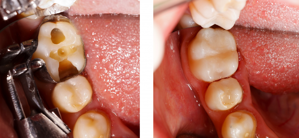 Болит зуб под пломбой 3