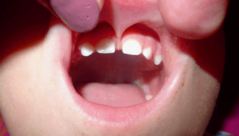 аномальная уздечка верхней губы