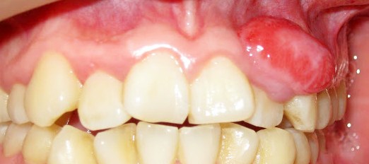 granulema-zuba