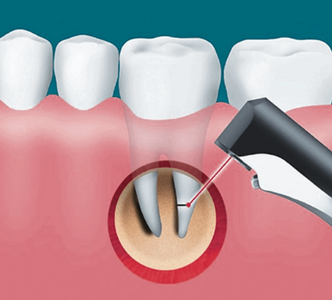гемисекция зуба показания