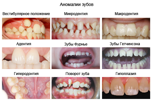 anomalii-polozheniya-zubov1