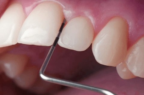 кюретаж при удалении зуба