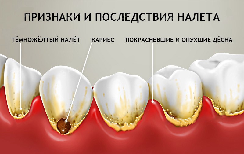 zubnoj-nalet1.jpg
