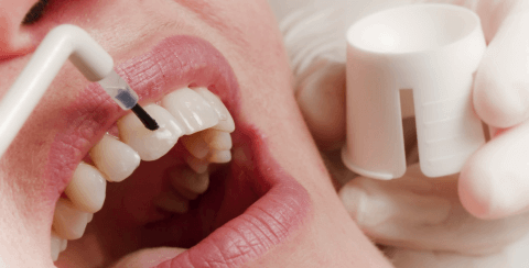 глубокое фторирование зубов
