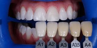 otbelivanie-zubov-zoom2