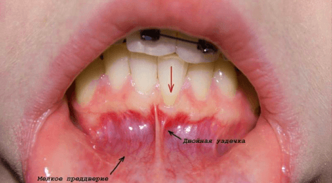 Аномальное преддверие полости рта
