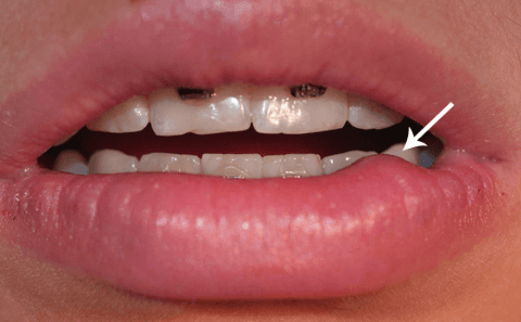 Ретенционная киста нижней губы