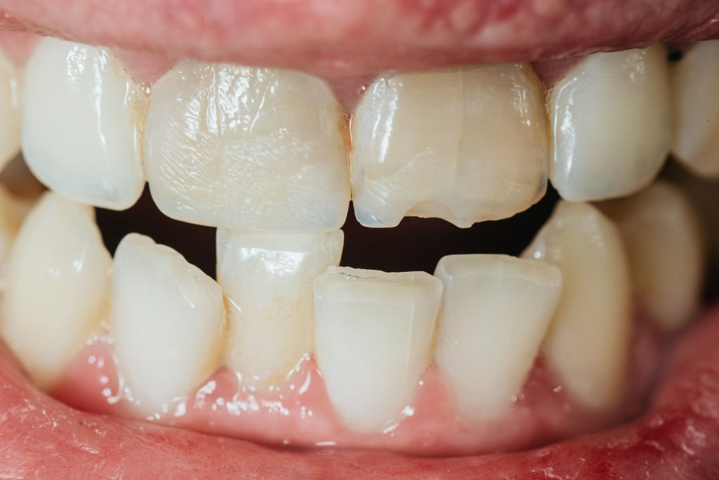 Симптомы дистопированных зубов