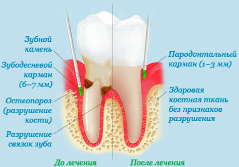 закрытый кюретаж зубов