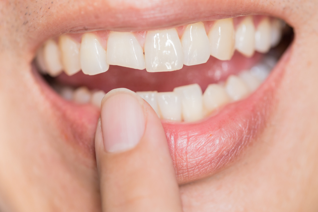 Симптомы переломов зубов