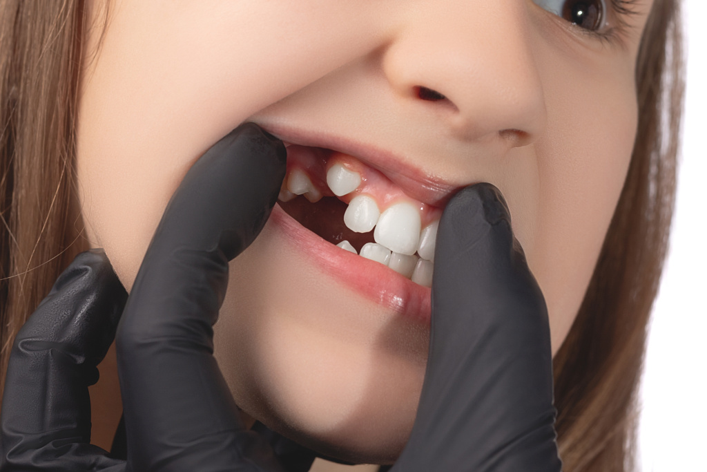 Причины дистопированных зубов